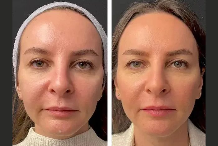 Mesotherapy in Dubai